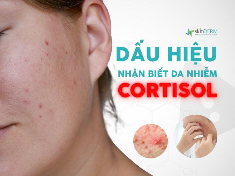 Dấu hiệu nhiễm Corticol