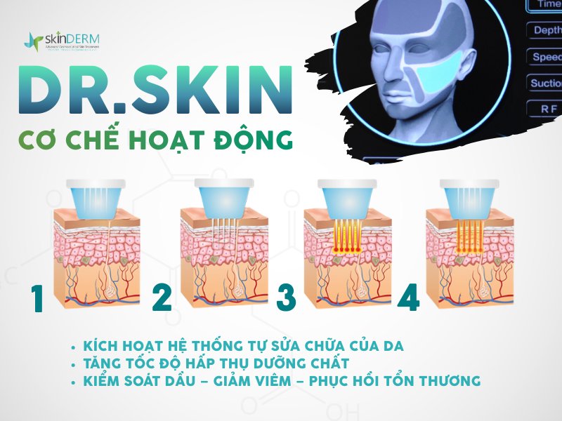 Cơ chế hoạt động máy RF Needle