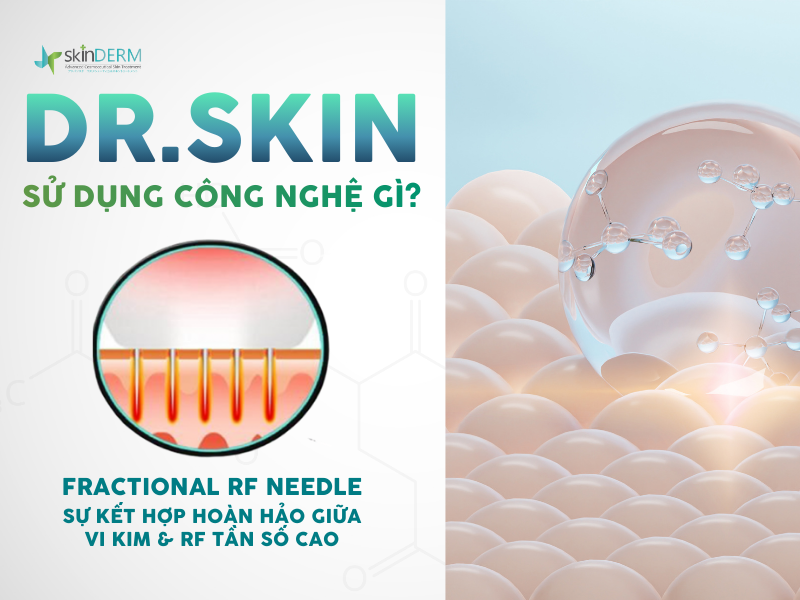 Công nghệ của RF Needle